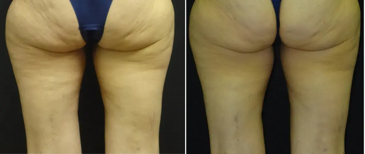 Gambe prima e dopo VelaShape: la pelle appare più liscia e tonica, con una riduzione visibile della cellulite.