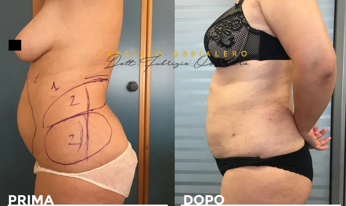 Addome prima e dopo liposcultura: il fianco sinistro mostra le marcature pre-operatorie, il fianco destro il risultato.