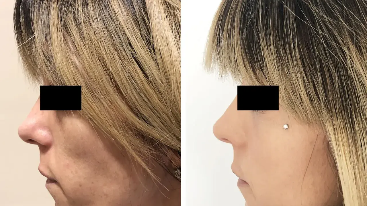 Prima e dopo lipofilling viso: il lato sinistro mostra un viso con contorni meno definiti, il destro un viso più armonioso. Esperienze negative da valutare.