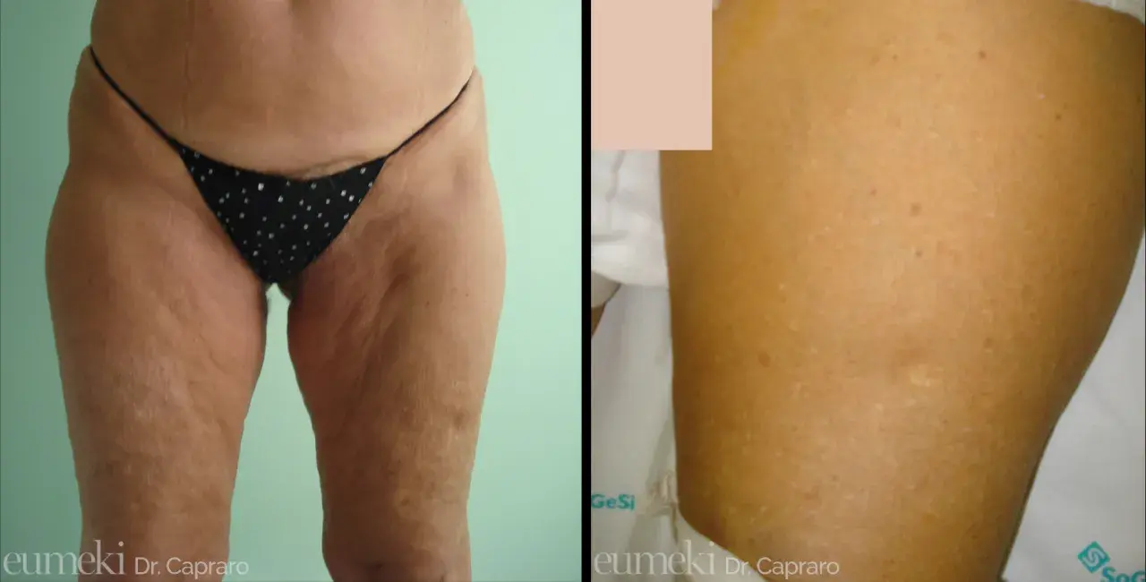Lifting cosce: prima e dopo, con attenzione alle cicatrici e alla texture della pelle.