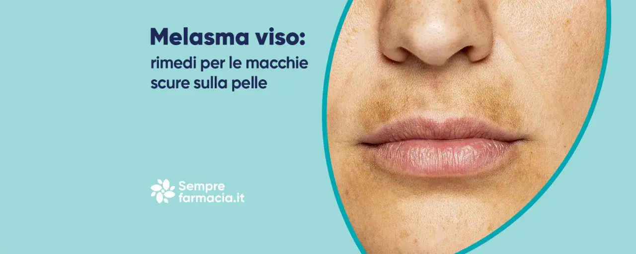 Primo piano del viso con melasma, evidenziando la zona baffetti scura e macchie sulla pelle. Rimedi per il melasma.