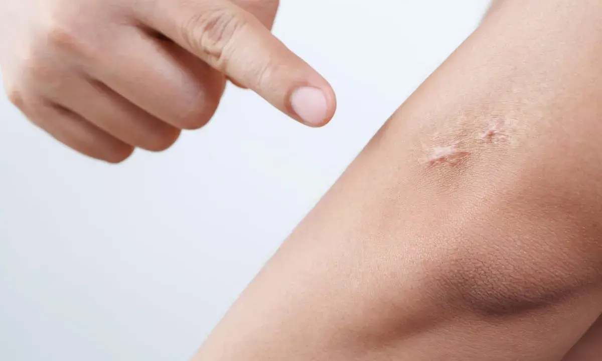 Dito si vede un dito che indica una cicatrice rialzata sulla pelle. Questa è una cheloide, una crescita anomala di tessuto cicatriziale.
