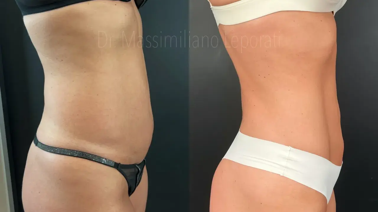 Profilo addome e fianchi prima e dopo vaser lipo. La silhouette è visibilmente più definita e snella.