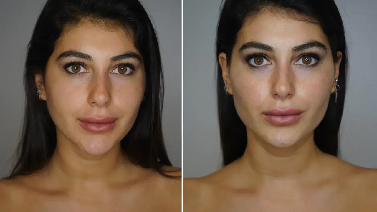 Prima e dopo: un volto femminile con labbra più piene e un contorno mascella definito, suggerendo un trattamento di filler mascella donna.