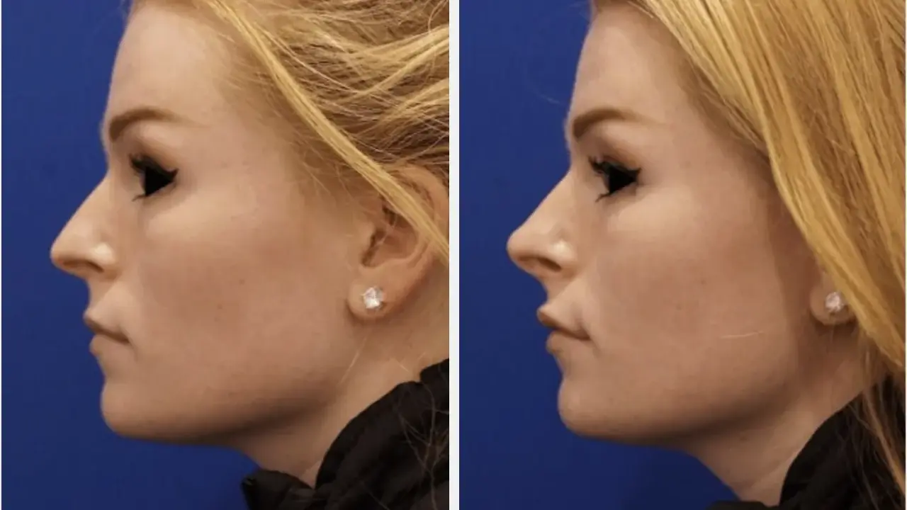 Profilo di donna prima e dopo rinofiller naso frontale. Il trattamento ha migliorato la linea del naso e del mento.