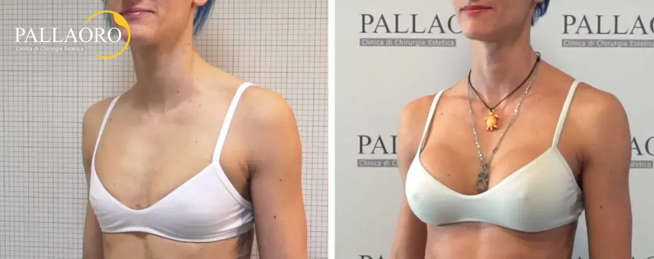 Prima e dopo: seno rifatto taglia 2, un risultato naturale e armonioso.