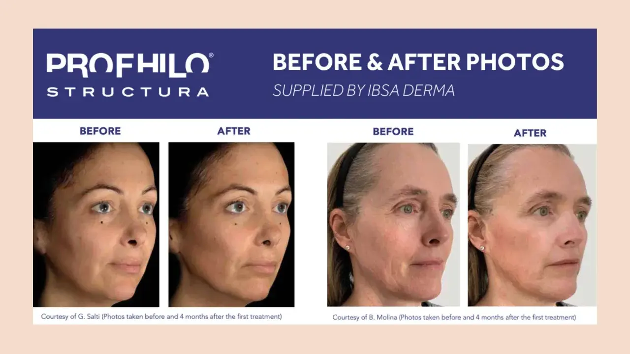 Profhilo Body: risultati prima e dopo. Due donne mostrano miglioramenti visibili della pelle dopo il trattamento.