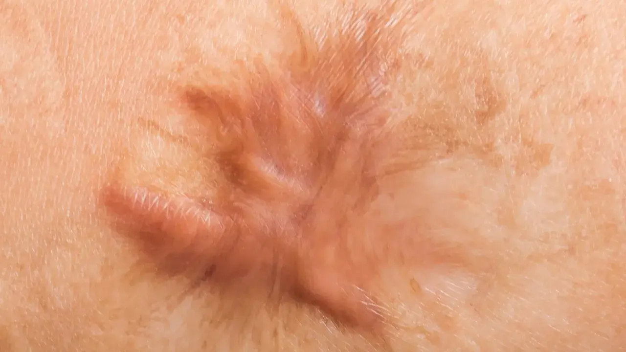 Primo piano di pelle con un segno che ricorda una foglia, risultato di tessuto cicatriziale interno.