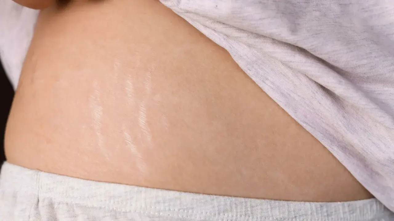 Pelle con smagliature sul fianco, segno di cambiamenti corporei.