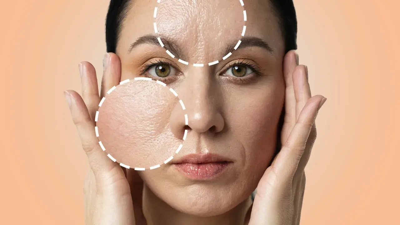 Primo piano di una donna con cerchi tratteggiati che evidenziano rughe e pori dilatati, suggerendo un trattamento di peeling.