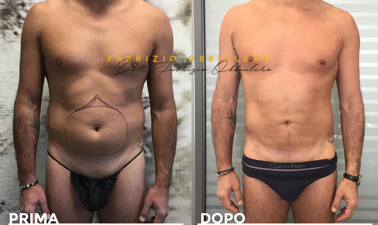 Prima e dopo liposuzione pube uomo. Addome più definito e tonico, con contorni migliorati.