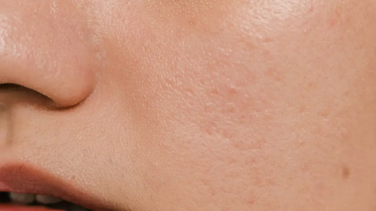 Pelle arrossata e screpolata, con piccole imperfezioni, tipica di un'ustione o un peeling chimico.
