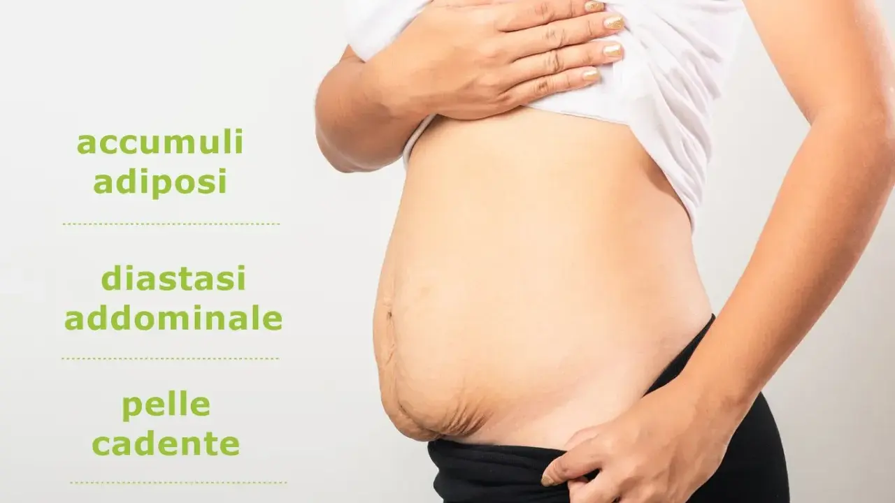 Addominoplastica cos'è: immagine mostra addome con accumuli adiposi, diastasi addominale e pelle cadente, condizioni trattabili.