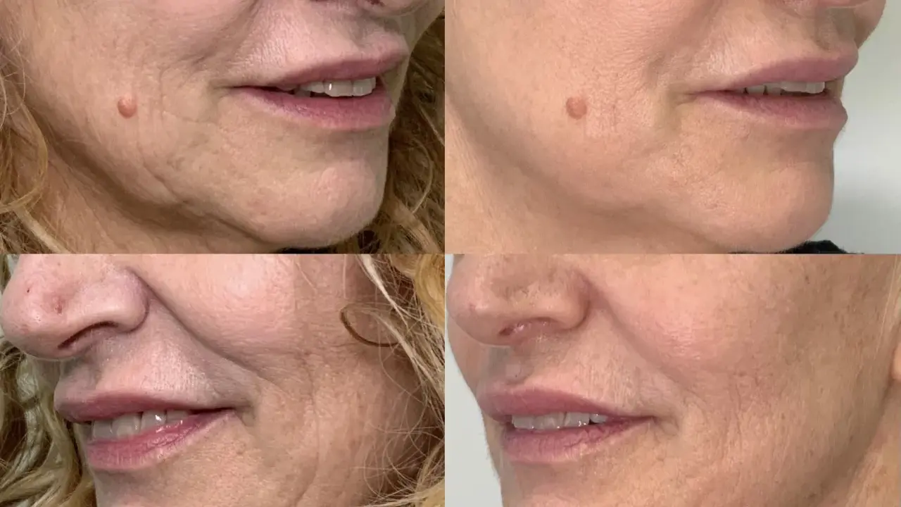 Punture di vitamine viso prima e dopo: la pelle appare più liscia e luminosa, con una riduzione delle rughe e un aspetto più giovane.