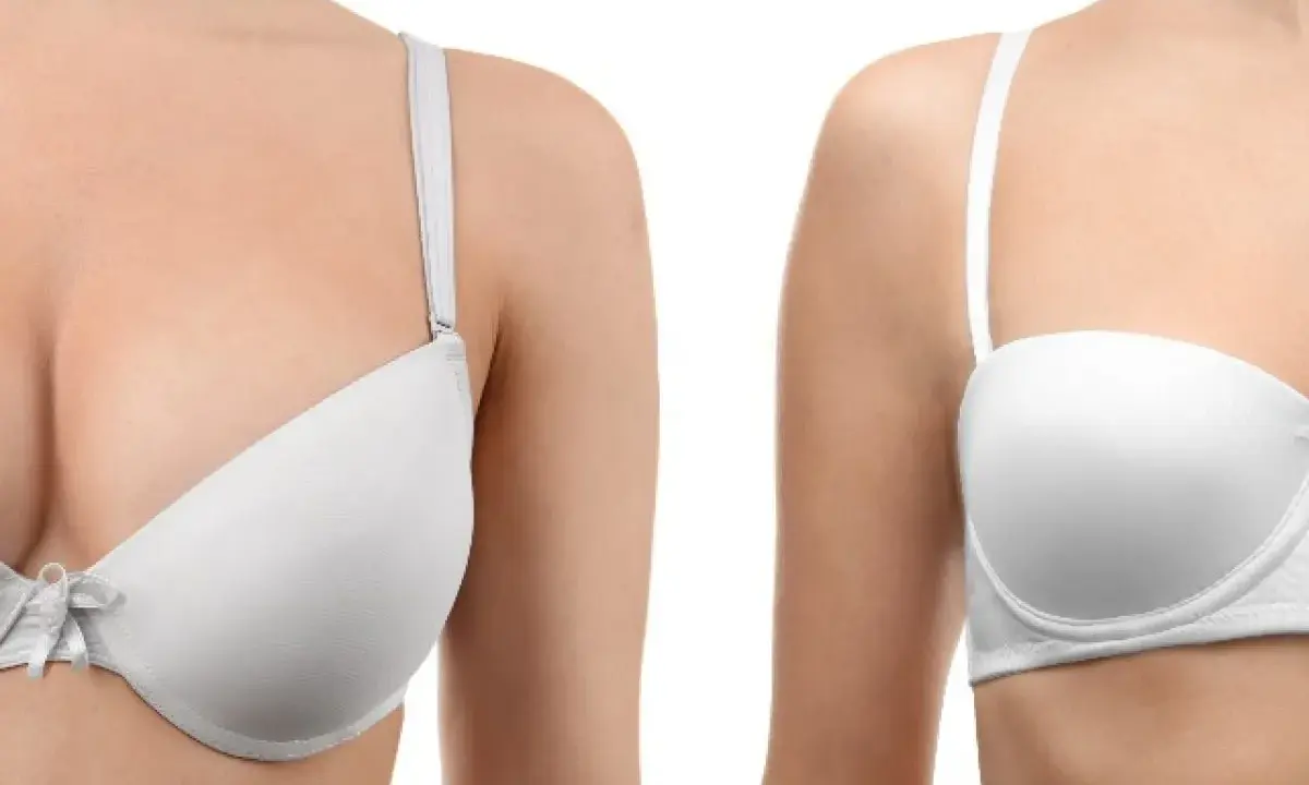 Primo piano di un seno rifatto taglia 4 a goccia, con un reggiseno bianco.
