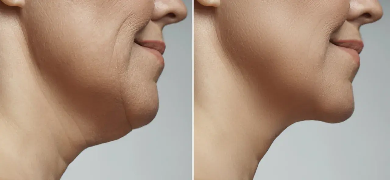 Prima e dopo criolipolisi doppio mento: recensioni positive per un viso più definito e giovane.