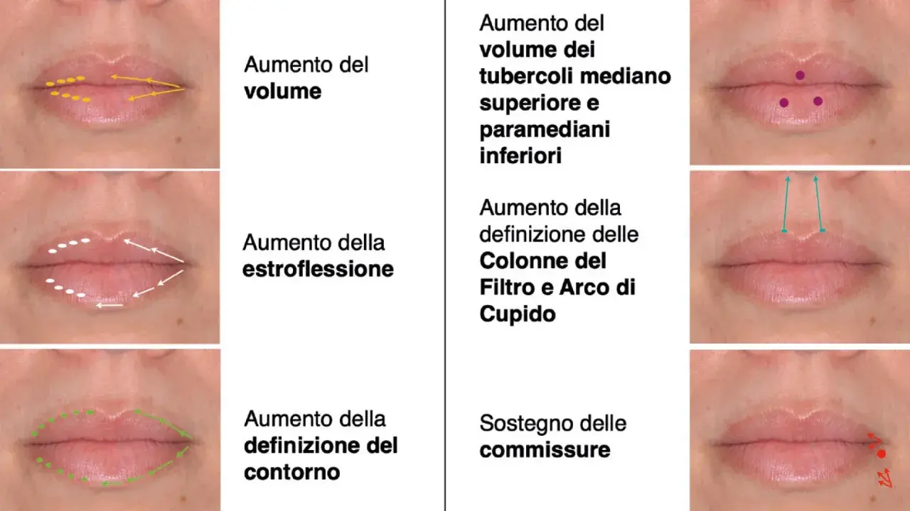Filler per migliorare volume, estroflessione, definizione contorno, tubercoli, colonne del filtro, arco di Cupido e sostegno delle commissure della bocca.