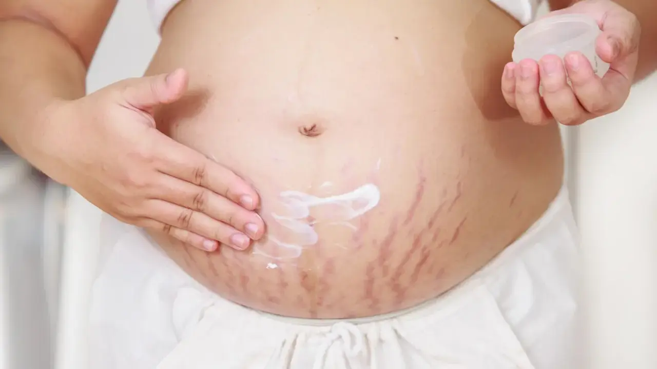 Pancia con smagliature rosse, una mano applica crema idratante per capire perchè vengono le smagliature.