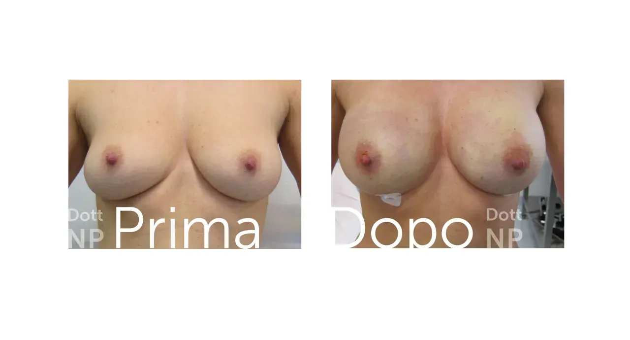 Prima e dopo: un confronto visivo che mostra un aumento del volume del seno, trasformando tette piccole in forme più piene e definite.