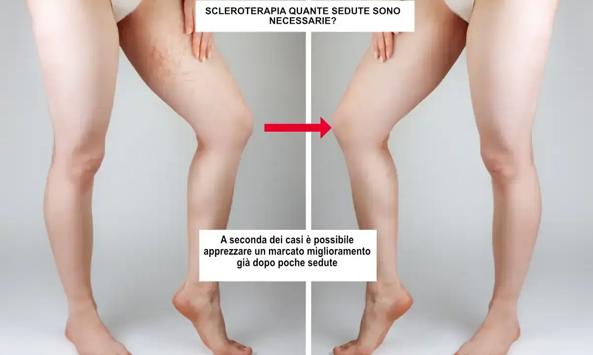 Gambe prima e dopo sclerosanti: la terapia riduce visibilmente le teleangectasie, mostrando un netto miglioramento.