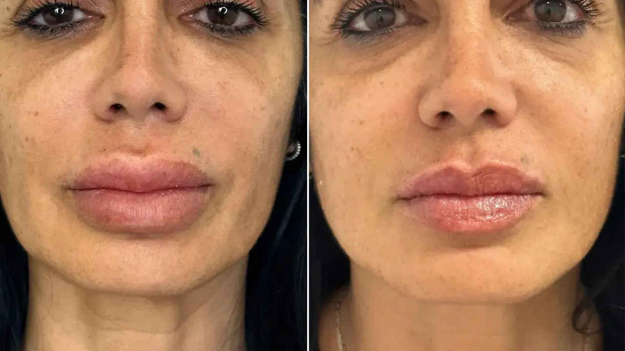 Volto prima e dopo ialuronidasi: labbra più definite e pelle più liscia.
