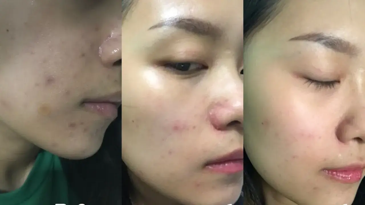 Acne migliorata con acido salicilico: prima, dopo 1 mese e dopo 2 mesi.
