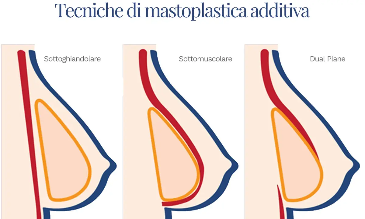 Illustrazione delle tecniche di mastoplastica additiva: sottoghiandolare, sottomuscolare e Dual Plane. Le opinioni sulla tecnica Dual Plane variano.