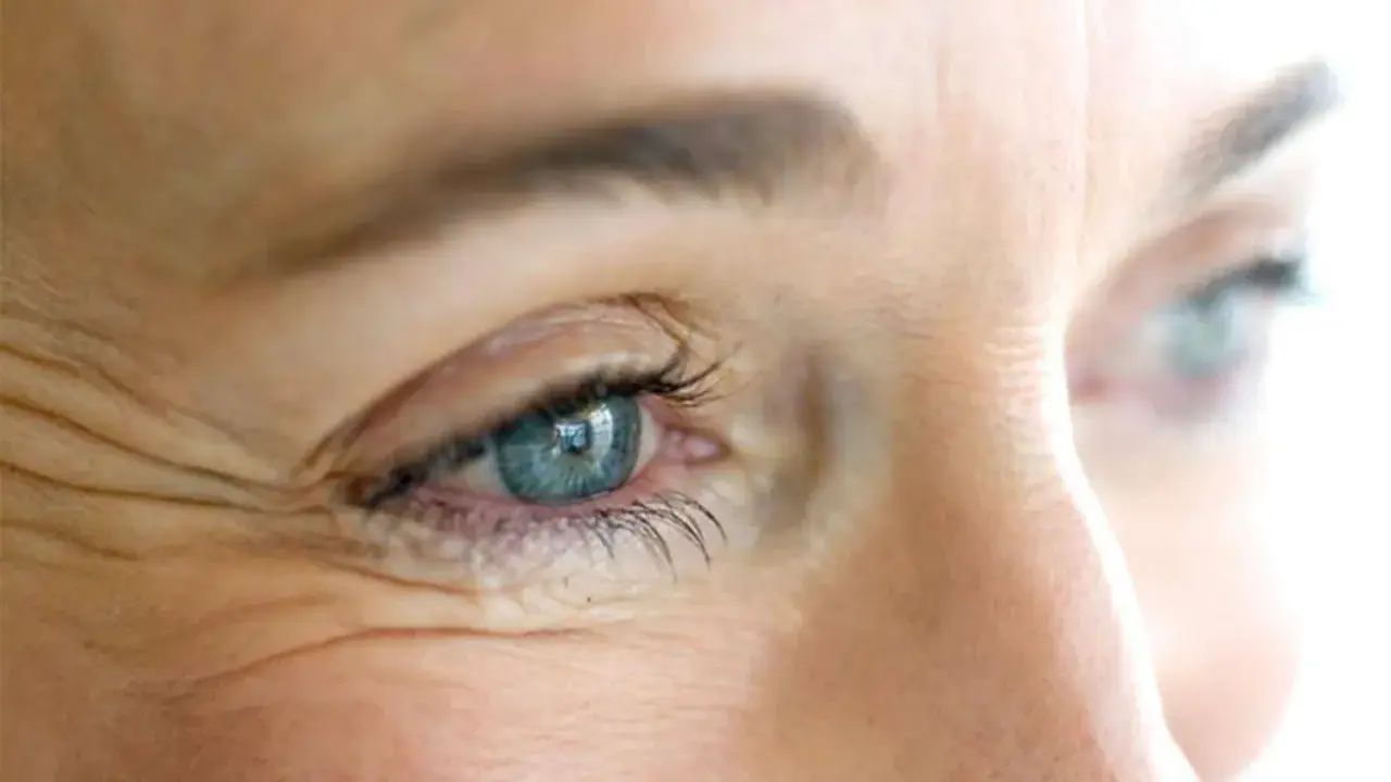Occhio con evidenti zampe di gallina, un segno del tempo che il botox può attenuare per un aspetto più giovane.