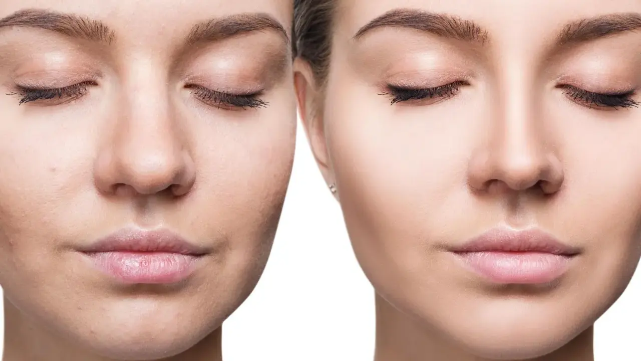 Viso prima e dopo: pelle imperfetta e spenta a sinistra, pelle luminosa e levigata a destra.