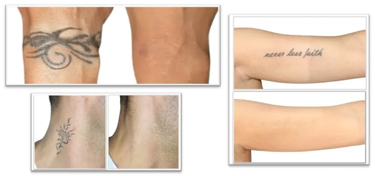 Prima e dopo la rimozione tatuaggi: braccio con tatuaggio tribale e braccio senza, collo con tatuaggio floreale e collo senza, braccio con scritta "never lose faith" e braccio senza.