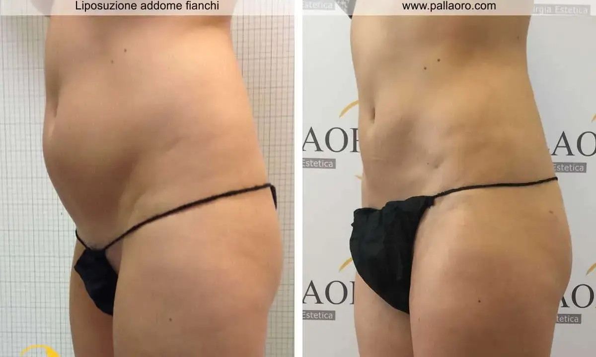Addome e fianchi prima e dopo liposuzione. La silhouette è visibilmente più snella e definita.
