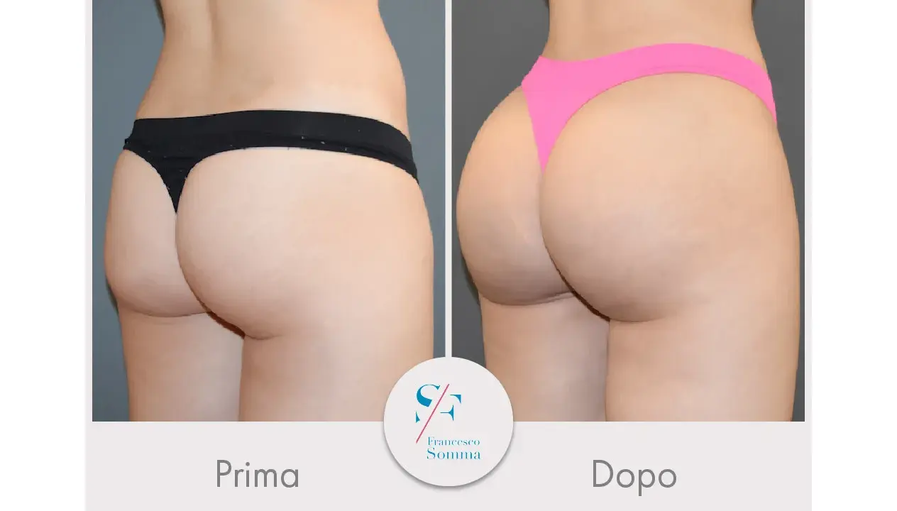 Risultati vaser lipo prima e dopo: glutei più voluminosi e scolpiti.
