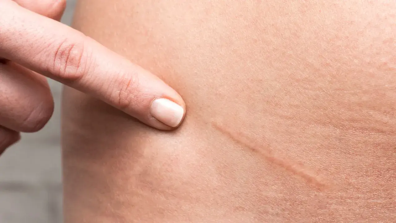 Dito indica una cicatrice da taglio, un segno che si può eliminare per una pelle più liscia.