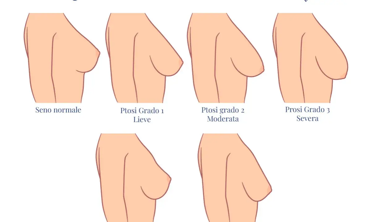 Illustrazione dei gradi di ptosi mammaria: seno normale, lieve, moderata, severa, pseudo ptosi e maldistribuzione. Il seno rifatto può diminuire nel tempo.
