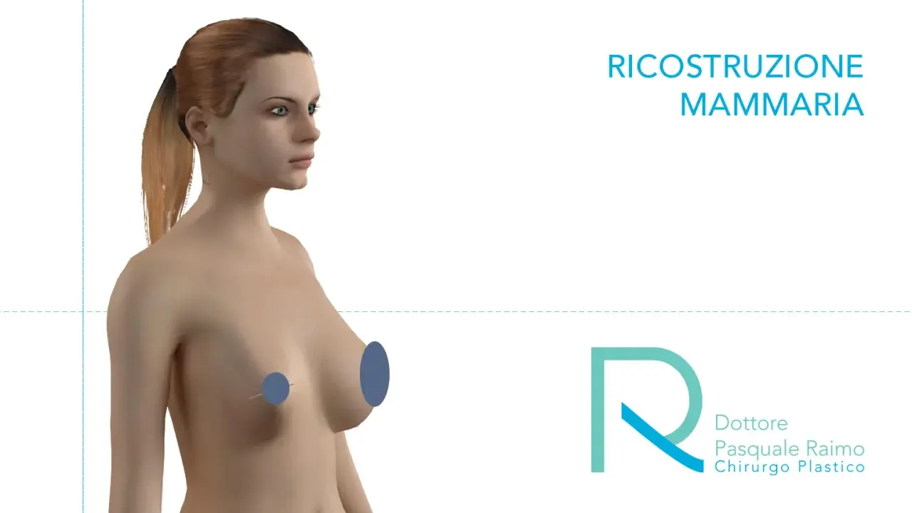 Modello 3D di un torace femminile, con aree evidenziate per illustrare la mastectomia e la ricostruzione mammaria.