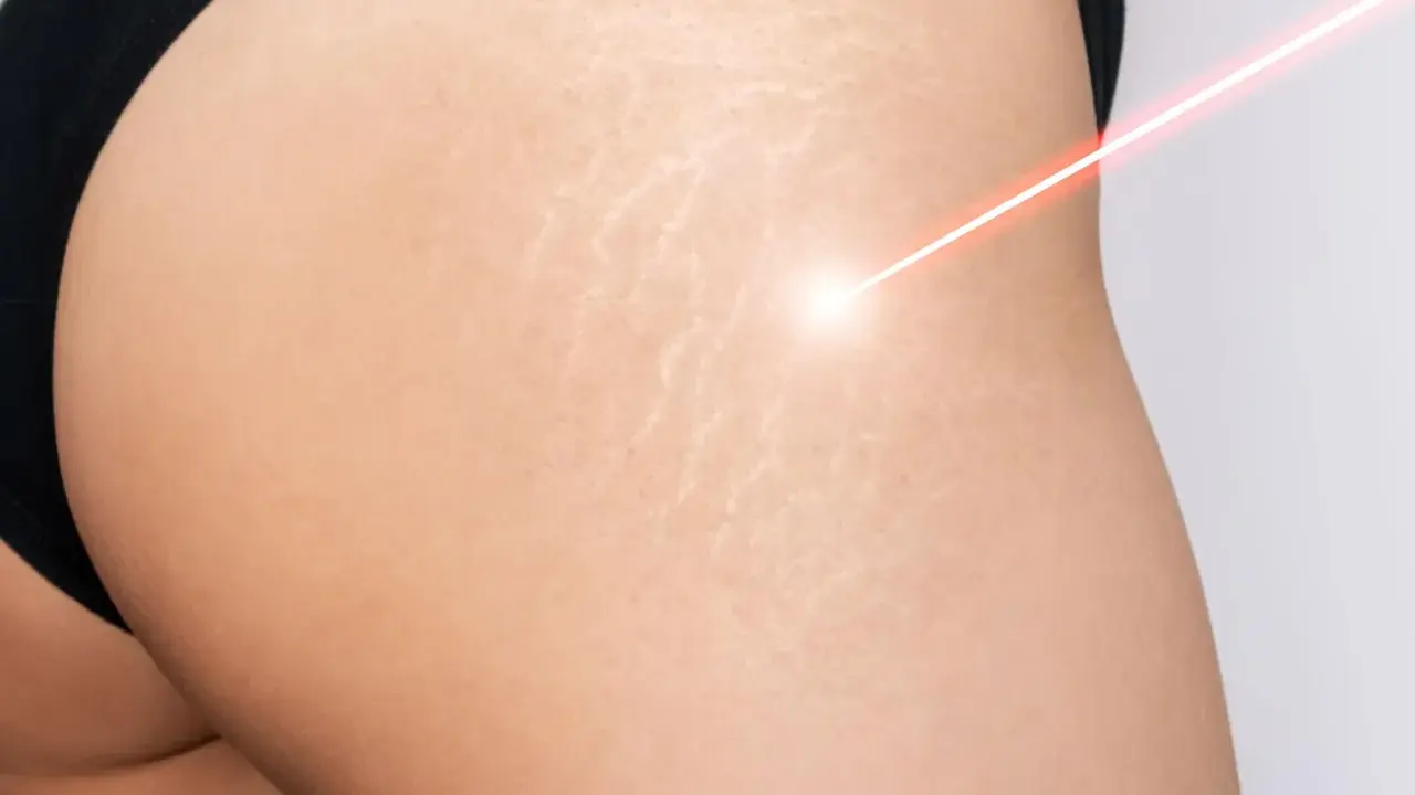 Laser treatment on skin with smagliature, showing a path to come eliminare le smagliature.