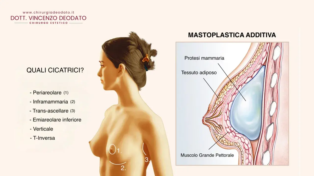 Illustrazione anatomica di un seno con protesi mammaria. Si evidenziano le possibili cicatrici post-mastoplastica e la posizione della protesi rispetto al muscolo pettorale.
