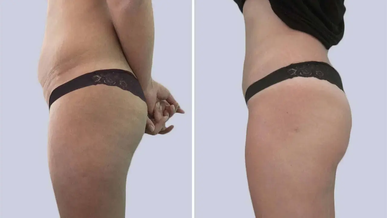 Confronto prima e dopo: la liposuzione come funziona per rimodellare il corpo, riducendo accumuli adiposi e migliorando la silhouette.