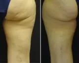 Gambe prima e dopo VelaShape: la pelle appare più liscia e tonica, con una riduzione visibile della cellulite.