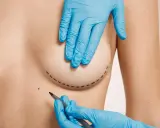 Mani guantate disegnano il contorno del seno per un intervento. Le cicatrici del seno rifatto sono un ricordo del percorso di trasformazione.