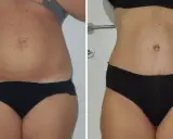 Addominoplastica prima e dopo: un confronto che mostra la trasformazione del ventre, con una pelle più tonica e una silhouette più definita.
