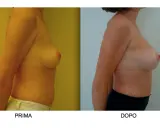 Confronto seno rifatto prima e dopo: immagine mostra il profilo di una donna, prima e dopo un intervento di mastoplastica additiva, evidenziando il cambiamento.
