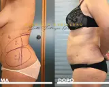 Addome prima e dopo liposcultura: il fianco sinistro mostra le marcature pre-operatorie, il fianco destro il risultato.