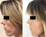 Prima e dopo lipofilling viso: il lato sinistro mostra un viso con contorni meno definiti, il destro un viso più armonioso. Esperienze negative da valutare.