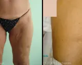 Lifting cosce: prima e dopo, con attenzione alle cicatrici e alla texture della pelle.