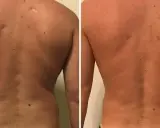 Risultati visibili di liposuzione schiena prima e dopo: la schiena appare più definita e liscia, con una riduzione del grasso accumulato.