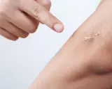 Dito si vede un dito che indica una cicatrice rialzata sulla pelle. Questa è una cheloide, una crescita anomala di tessuto cicatriziale.