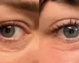 Occhi prima e dopo peeling TCA: rughe attenuate e pelle più liscia.