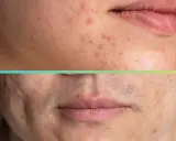 Primo piano di un volto diviso orizzontalmente. La parte superiore mostra la pelle con brufoli attivi e rossori. La parte inferiore rivela **cicatrici da brufoli** più profonde e visibili, con peli radi.
