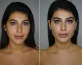 Prima e dopo: un volto femminile con labbra più piene e un contorno mascella definito, suggerendo un trattamento di filler mascella donna.
